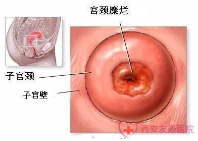 宫颈肥大目前都有哪些治疗方法