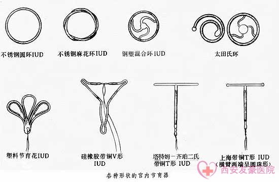 节育环的种类图片及节育环的选择