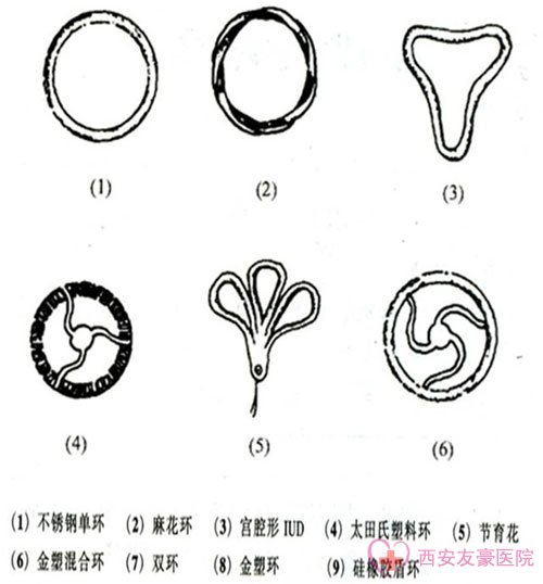 节育环的种类图片及节育环的选择